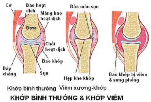 cac-benh-xuong-khop-thuong-gap