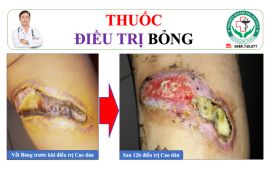 Điều trị vết bỏng gây lở loét da bằng cao dán Đông y tại Thái Bình