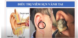 Cách chữa viêm sụn vành tai tại nhà bằng Cao dán vết thương Đông y