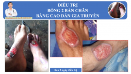 Điều trị vết bỏng gây lở loét da bằng cao dán Đông y tại Hưng Yên