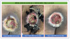 Điều trị lở loét da bằng cao dán Đông y tại Khánh Hòa