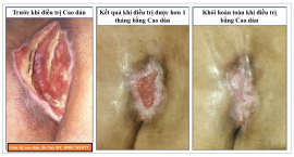 Điều trị lở loét da bằng cao dán Đông y tại Nghệ An