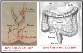 Điều trị rò hậu môn ở trẻ sơ sinh tại Hà Nội