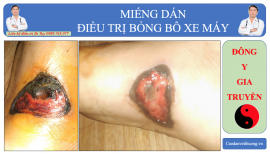 Điều trị vết bỏng gây lở loét da bằng cao dán Đông y tại Phú Thọ