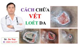 Tư vấn điều trị loét da tỳ đè tại Hà Nội