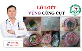 Điều trị hoại tử lở loét da tại Quảng Ninh