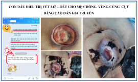 Nhận tư vấn và điều trị loét da tì đè tại Ninh Thuận