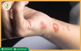 10 Bước Giúp Giảm Đau Rát Vết Bỏng Nhanh Chóng và Hiệu Quả Tại Nhà