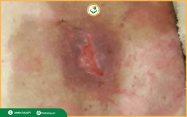 5 sai lầm phổ biến khiến vết loét lâu lành và cách phòng tránh hiệu quả nhất