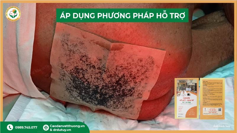 ap-dung-phuong-phap-ho-tro-som-cho-loet-cung-cut