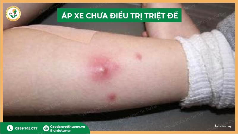 ap-xe-chua-dieu-tri-triet-de