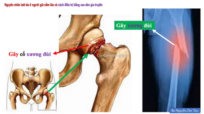 bac-si-tuy-chua-lanh-lo-loet-da-o-nguoi-gia-do-gay-xuong-dui