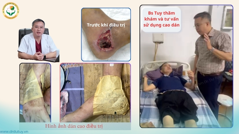 bac-si-tuy-tu-van-cao-dan-dieu-tri-vet-thuong-got-chan