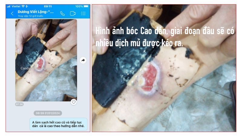 băng vết bỏng sau dán cao