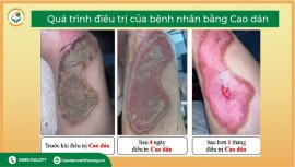 Bị Bỏng Bao Lâu Thì Lành? Tiến Trình Phục Hồi Theo Cấp Độ