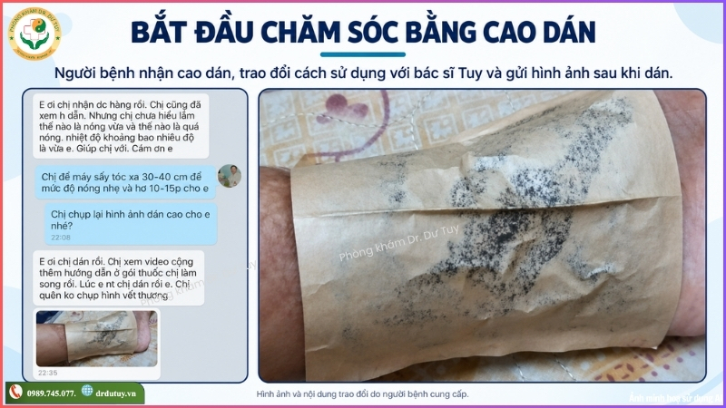 bat-dau-cham-soc-vet-loet-bang-cao-dan