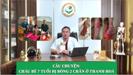 Bé 7 Tuổi Khỏi Bỏng Nước Sôi Nhờ Cao Dán Thảo Dược
