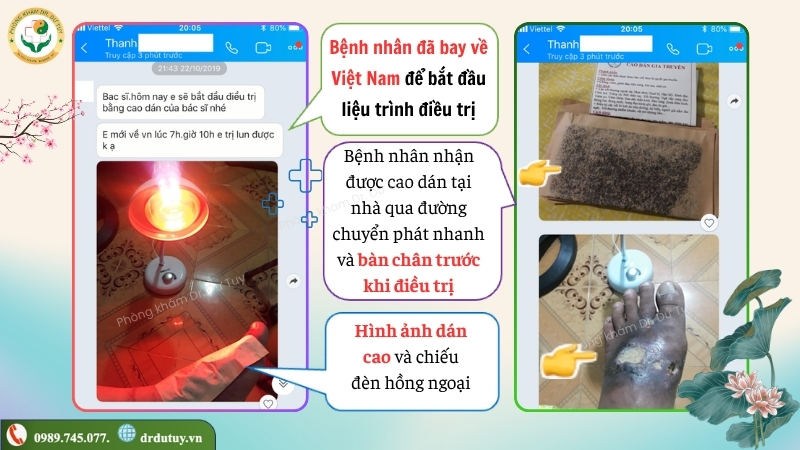 benh-nhan-bat-dau-cham-soc-loet-ban-chan