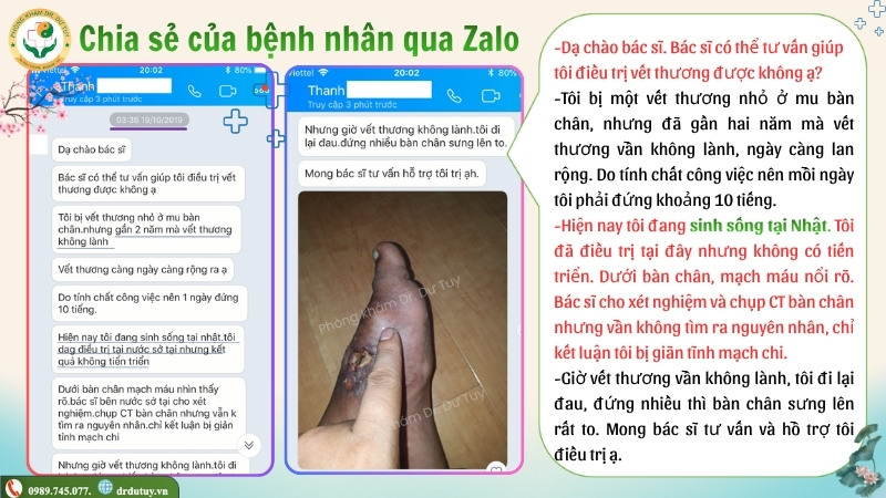 benh-nhan-chia-se-vet-loet-ban-chan-lau-lanh