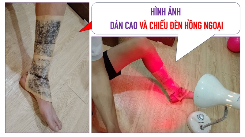 Bị bỏng nên làm gì?