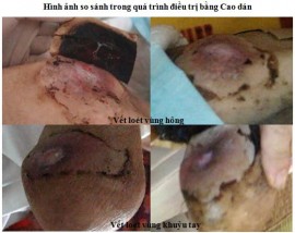 Bí quyết chữa loét da mau lành không dùng kháng sinh tại Thái Nguyên