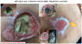 Bí quyết chữa loét da mau lành không dùng kháng sinh tại Tuyên Quang
