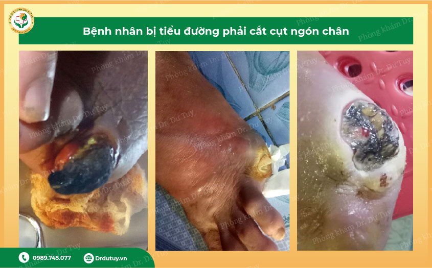 bien-chung-ban-chan-do-tieu-duong3