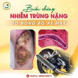 Biến chứng nhiễm trùng nặng do bỏng bô xe máy