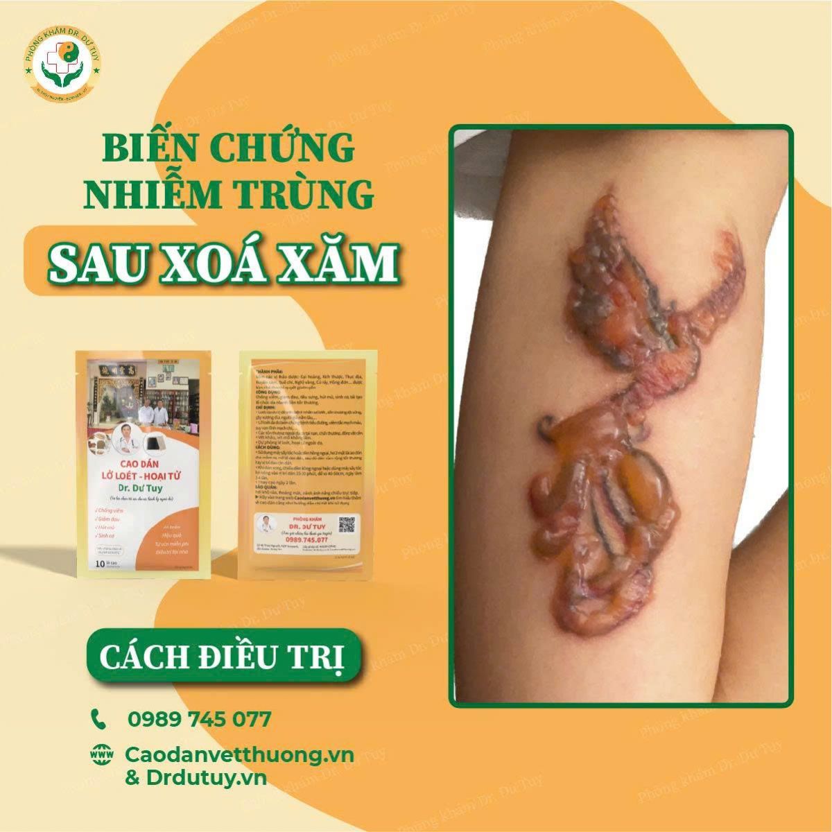 bien-chung-nhiem-trung-sau-xoa-xam