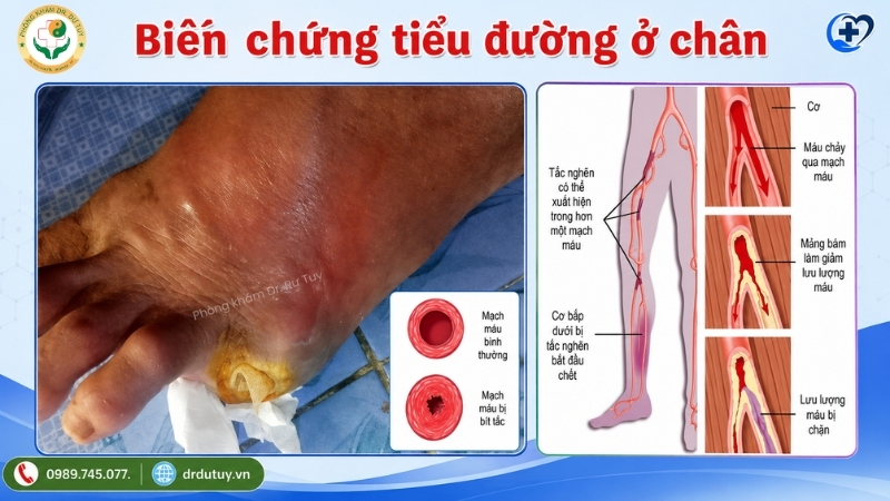 bien-chung-tieu-duong-o-chan-tac-nghen-mach-mau