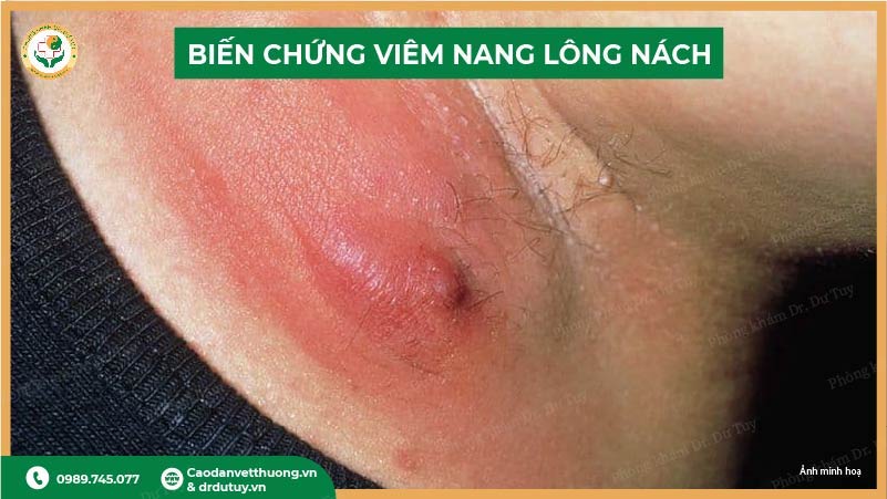 bien-chung-viem-nang-long-nach