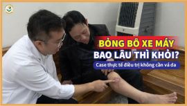 Bỏng bô xe máy bao lâu thì khỏi? Case thực tế điều trị không cần vá da