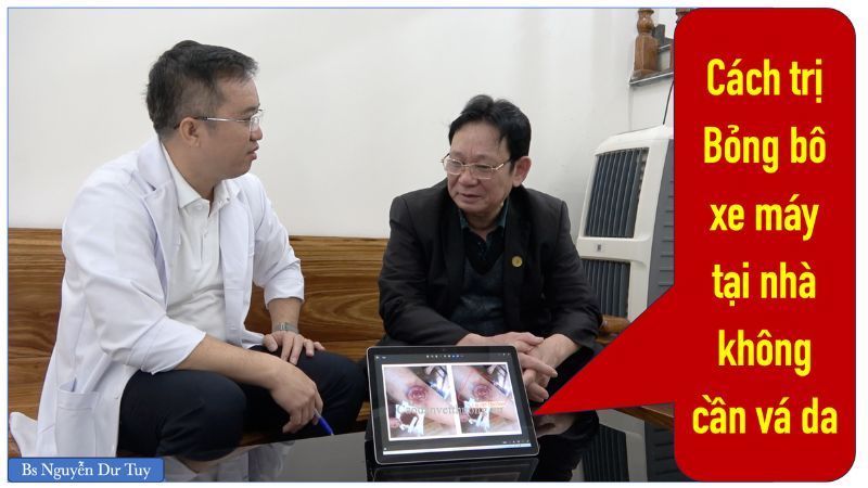 bỏng bô xe máy bs Dư Tuy