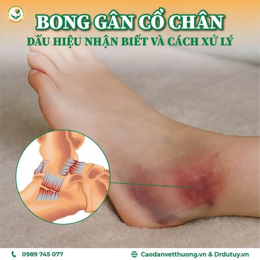 bong-gan-co-chan-dau-hieu-nhan-biet-va-huong-dan-xu-ly-dung-cach