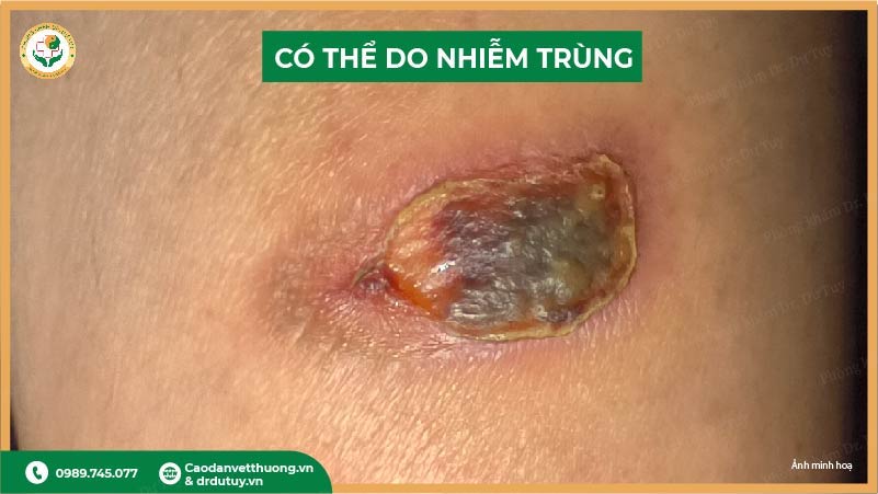 bỏng nhẹ lâu lành có thể do nhiễm trùng