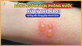 Bỏng nước sôi bị phồng nước xử lý thế nào? Hướng dẫn đúng giúp nhanh lành