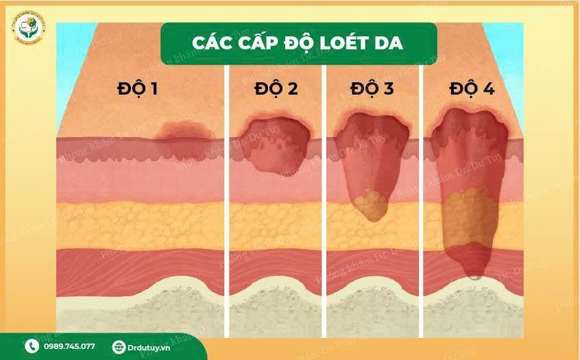 cac-cap-do-loet-da(3)