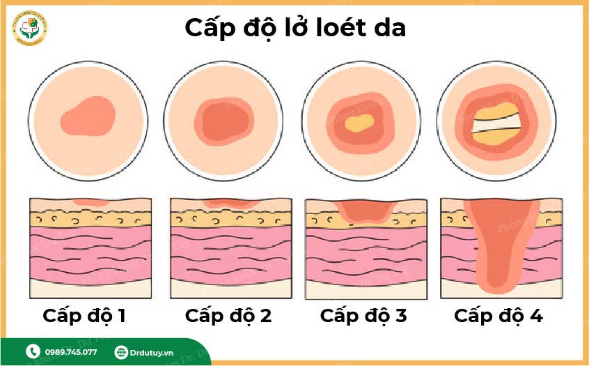 cac-cap-do-loet-da(4)