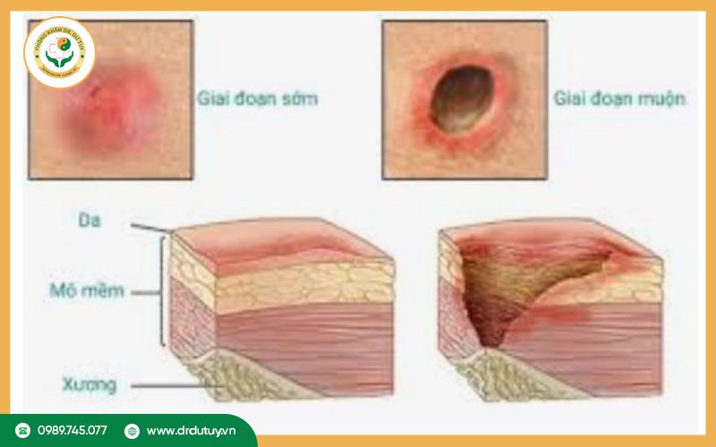 cac-giai-doan-loet-ti-de-anh2