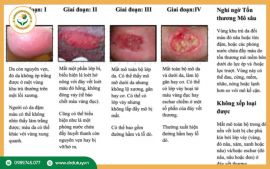 Các Giai Đoạn Loét Tì Đè: Nhận Biết Sớm Để Chăm Sóc Hiệu Quả