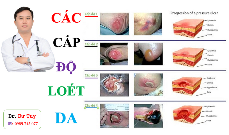 cac-giai-doan-loet-ti-de-va-cach-dieu-tri-hieu-qua