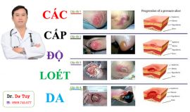 Các giai đoạn loét tì đè và cách điều trị hiệu quả