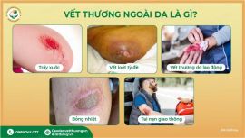 Quy trình sơ cứu và điều trị vết thương ngoài da: Những lưu ý quan trọng bạn cần biết
