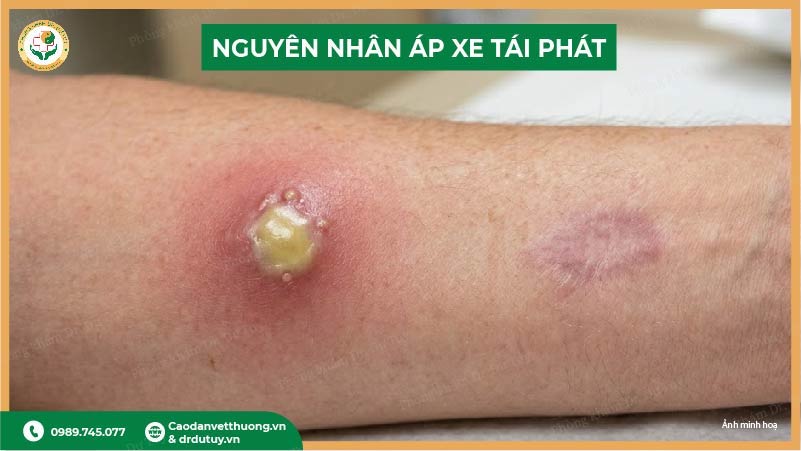 cac-nguyen-nhan-ap-xe-tai-phat