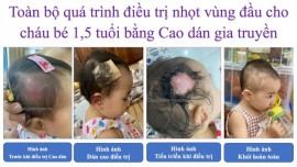 Cách chữa áp xe da ở trẻ nhỏ