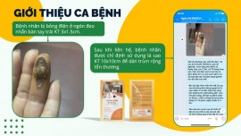 Bỏng Điện Nặng : Bí Quyết Phục Hồi Ngón Tay Chỉ Trong 25 Ngày