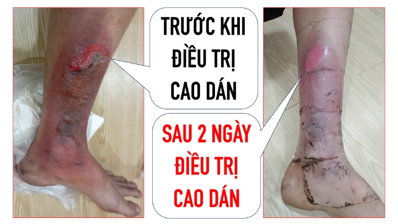 Cách chữa bỏng nước sôi bị phồng