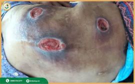 Cách điều trị và chăm sóc loét da vùng lưng cho người nằm lâu hiệu quả