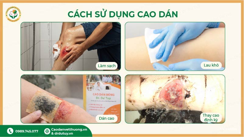 cách sử dụng cao dán trị bỏng đúng cách