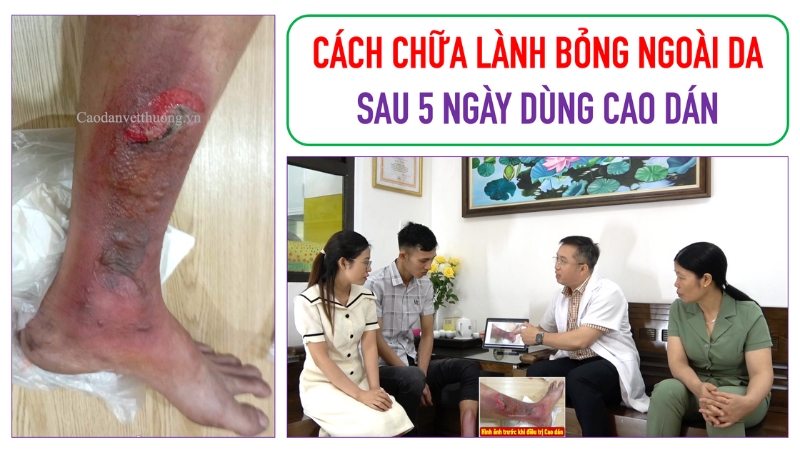 Cách trị bỏng